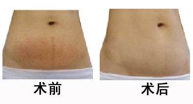 產(chǎn)后的妊娠紋能消除嗎