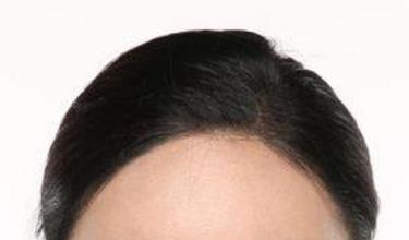 發(fā)際線<a href=http://www.sbs17.com/listinfo-10-0.html target=_blank class=infotextkey>整形價格</a>