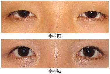 上瞼下垂價(jià)格