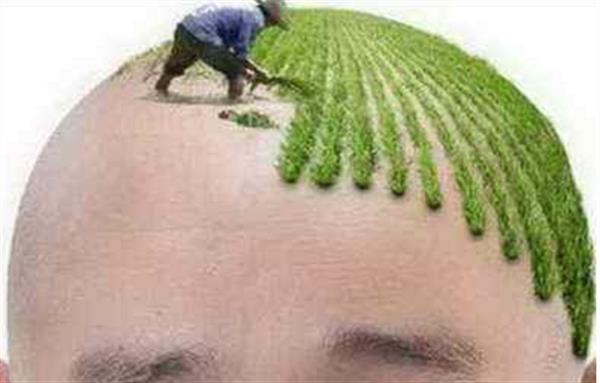 植發(fā)貴嗎