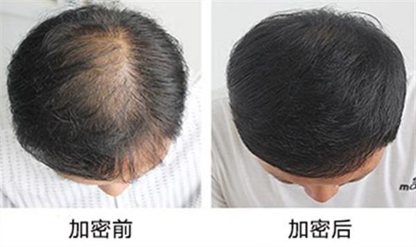 植發(fā)價格多少錢