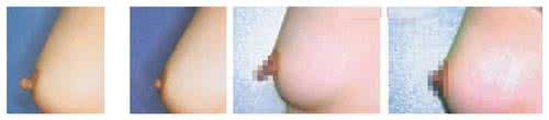 乳頭縮小術(shù)多久可以恢復(fù)