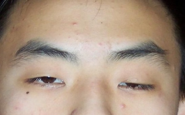 眼瞼下垂矯正術(shù)費(fèi)用
