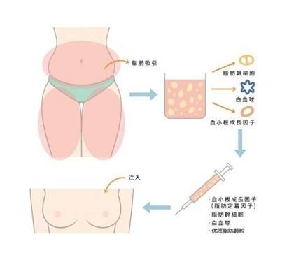注射<a href=http://www.sbs17.com/listinfo-618-0.html target=_blank class=infotextkey>隆胸</a>價(jià)格