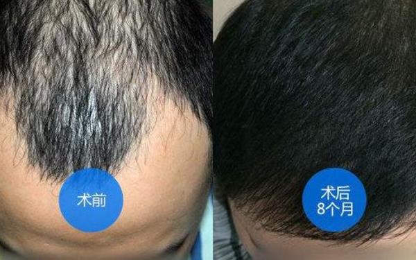 太原哪里治脫發(fā)