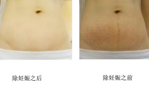 產(chǎn)后有妊娠紋怎么辦 哪家醫(yī)院<a href=http://www.sbs17.com/listinfo-791-0.html target=_blank class=infotextkey>去妊娠紋</a>好呢