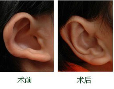 耳廓再造術(shù)的材料有哪些