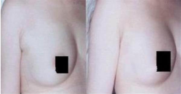 副乳切除術(shù)對(duì)腋臭有影響嗎