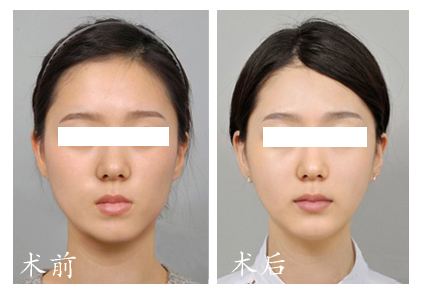 杭州注射<a href=http://www.sbs17.com/listinfo-737-0.html target=_blank class=infotextkey>隆鼻</a>的價(jià)錢