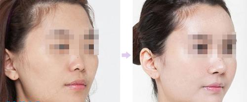 上海注射<a href=http://www.sbs17.com/listinfo-737-0.html target=_blank class=infotextkey>隆鼻</a>子需要多少錢