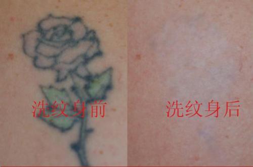 電灼去紋身優(yōu)點(diǎn)
