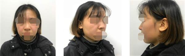 韓式<a href=http://www.sbs17.com/listinfo-737-0.html target=_blank class=infotextkey>隆鼻</a>前后對比照片案例