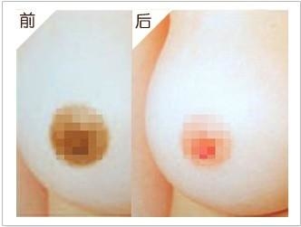什么是<a href=http://www.sbs17.com/listinfo-625-0.html target=_blank class=infotextkey>乳暈縮小</a>手術(shù)