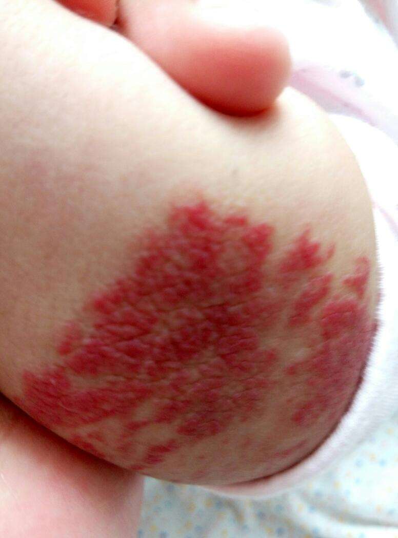 去紅色胎記多少錢？