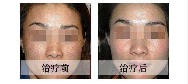 激光<a href=http://www.sbs17.com/listinfo-786-0.html target=_blank class=infotextkey>去黃褐斑</a>多少錢？