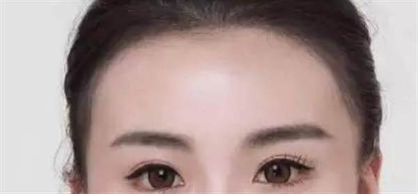 發(fā)際線后移能不能恢復(fù)