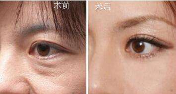 做完提眉術(shù)后的效果怎么樣？