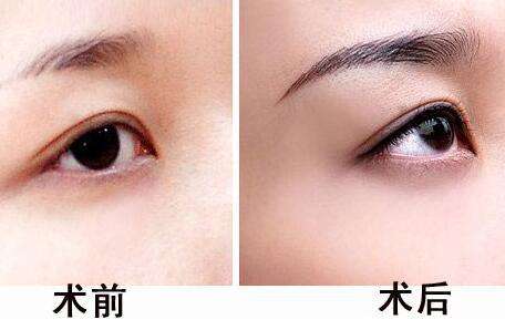 提眉手術(shù)費(fèi)用貴不貴？