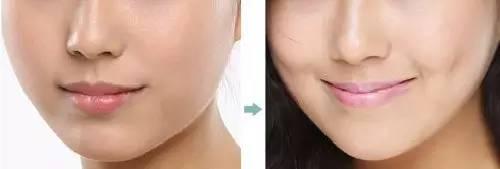 酒窩形成術(shù)的方法和效果怎么樣？