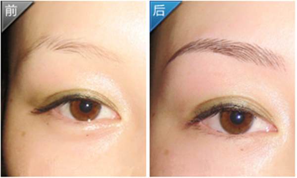 <a href=http://www.sbs17.com/listinfo-655-0.html target=_blank class=infotextkey>切眉</a>術(shù)的原理？