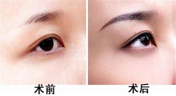 <a href=http://www.sbs17.com/listinfo-655-0.html target=_blank class=infotextkey>切眉</a>術(shù)與提眉術(shù)對比？