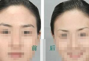 <a href=http://www.sbs17.com/listinfo-655-0.html target=_blank class=infotextkey>切眉</a>術(shù)的手術(shù)過程步驟及術(shù)后護理？