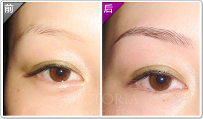 提眉術(shù)的恢復(fù)期是多久？