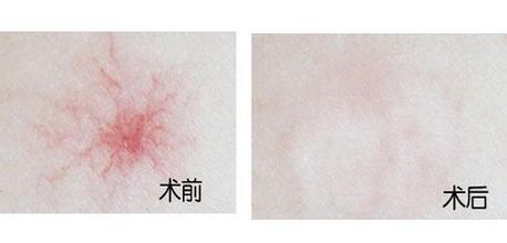 告訴你長(zhǎng)蜘蛛痣的原因是什么
