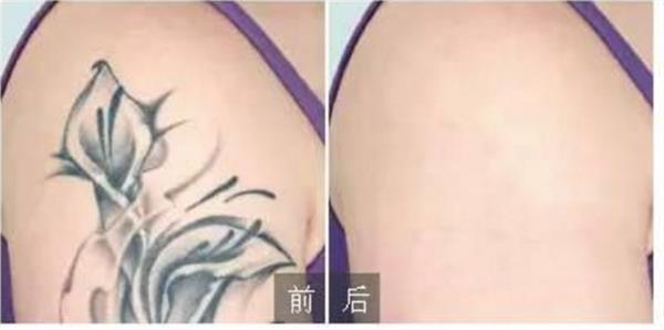 激光<a href=http://www.sbs17.com/listinfo-793-0.html target=_blank class=infotextkey>洗紋身</a>多久能好