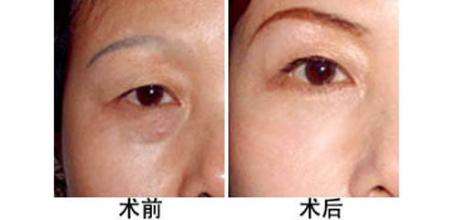 如何縮短<a href=http://www.sbs17.com/listinfo-655-0.html target=_blank class=infotextkey>切眉</a>術后的恢復期？