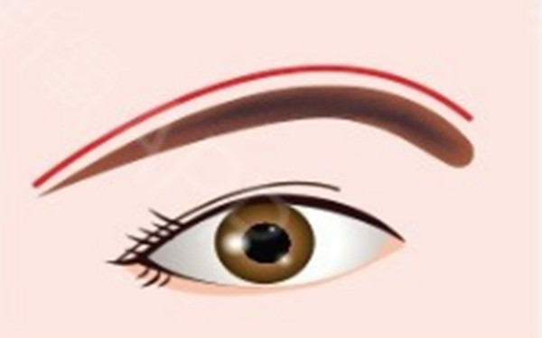 提眉術(shù)的手術(shù)設(shè)計操作怎樣？