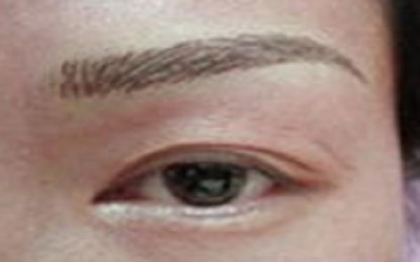 怎么樣避免提眉術(shù)的副作用？