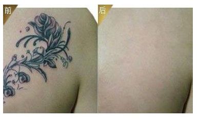 激光祛紋身多少錢(qián)