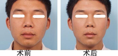 <a href=http://www.sbs17.com/listinfo-655-0.html target=_blank class=infotextkey>切眉</a>手術(shù)后老得快