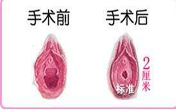 處女膜再造術(shù)的手術(shù)過(guò)程
