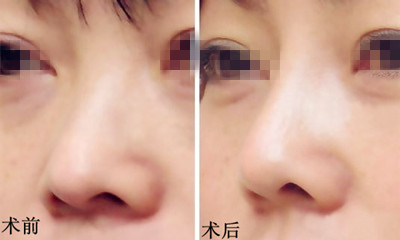 不良<a href=http://www.sbs17.com/listinfo-737-0.html target=_blank class=infotextkey>隆鼻</a>修復(fù)手術(shù)的方法