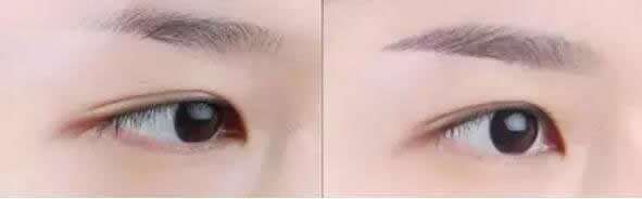 <a href=http://www.sbs17.com/listinfo-655-0.html target=_blank class=infotextkey>切眉</a>手術過程是怎樣的呢？