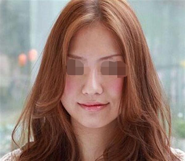 歪臉怎么矯正？多少錢(qián)？