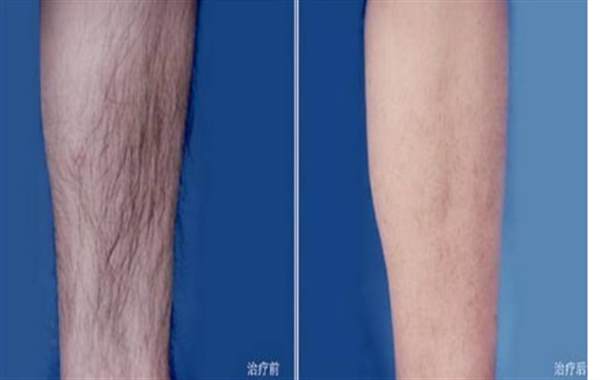 激光脫腿毛多少錢呢