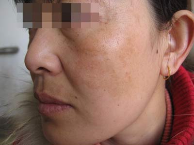 呼和浩特<a href=http://www.sbs17.com/listinfo-786-0.html target=_blank class=infotextkey>去黃褐斑</a>好的辦法的什么