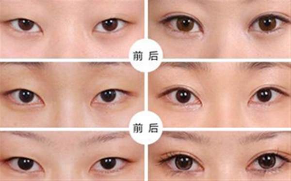 提眉術(shù)適合多大年齡做？