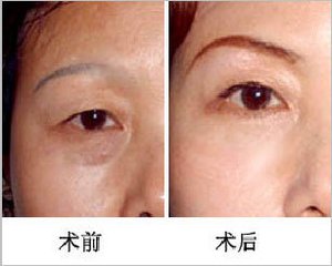提眉術(shù)適應(yīng)癥是？