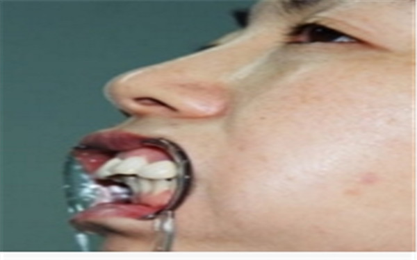 上頜整形手術(shù)過程