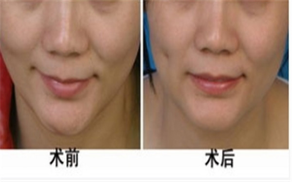 人造酒窩的方法具體有哪些呢? 