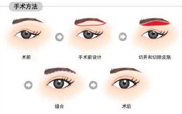 如何處理提眉術(shù)的并發(fā)癥呢？