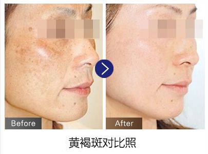 激光去黃有沒有副作用
