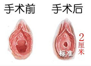 <a href=http://www.sbs17.com/listinfo-805-0.html target=_blank class=infotextkey>處女膜修復(fù)</a>前后對比圖