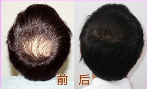 常見值發(fā)術(shù)后的護(hù)理方法
