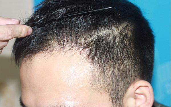 <a href=http://www.sbs17.com/listinfo-662-0.html target=_blank class=infotextkey>治療脫發(fā)</a>的方法