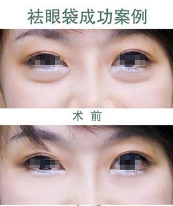 眼袋抽脂手術(shù)效果怎么樣  